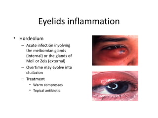 Eyelids inflammation
• Hordeolum
  – Acute infection involving
    the meibomian glands
    (internal) or the glands of
    Moll or Zeis (external)
  – Overtime may evolve into
    chalazion
  – Treatment
      • Warm compresses
      • Topical antibiotic
 