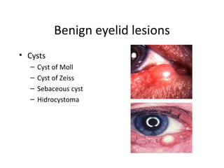 Benign eyelid lesions
• Cysts
  –   Cyst of Moll
  –   Cyst of Zeiss
  –   Sebaceous cyst
  –   Hidrocystoma
 