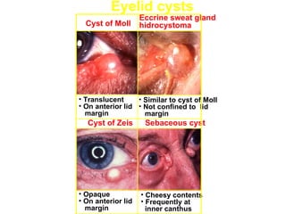 Eyelid cysts
                    Eccrine sweat gland
  Cyst of Moll      hidrocystoma




• Translucent     • Similar to cyst of Moll
• On anterior lid • Not confined to lid
  margin            margin
  Cyst of Zeis       Sebaceous cyst




• Opaque            • Cheesy contents
• On anterior lid   • Frequently at
  margin              inner canthus
 