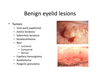 Benign eyelid lesions
• Tumors
  –   Viral wart( papilloma)
  –   Actinic keratosis
  –   Seborrheic keratosis
  –   Keratocanthoma
  –   Nevi
       • Junctional
       • Compound
       • Dermal
  – Capillary hemangioma
  – Xanthelasma
  – Pyogenic granuloma
 