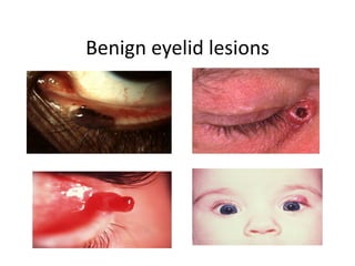 Benign eyelid lesions
 