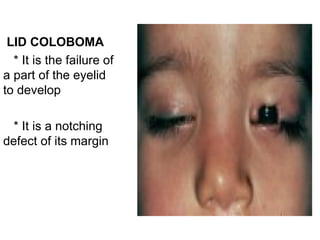 LID COLOBOMA
  * It is the failure of
a part of the eyelid
to develop

  * It is a notching
defect of its margin
 