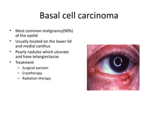 Basal cell carcinoma
•   Most common malignancy(90%)
    of the eyelid
•   Usually located on the lower lid
    and medial canthus
•   Pearly nodules which ulcerate
    and have telangiectasias
•   Treatment
     – Surgical excision
     – Cryotherapy
     – Radiation therapy
 