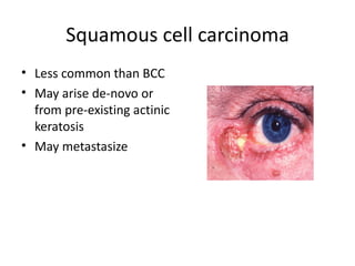 Squamous cell carcinoma
• Less common than BCC
• May arise de-novo or
  from pre-existing actinic
  keratosis
• May metastasize
 