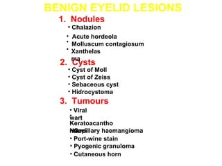 BENIGN EYELID LESIONS
  1. Nodules
    • Chalazion
   • Acute hordeola
   • Molluscum contagiosum
   • Xanthelas
      ma
  2. Cysts
    • Cyst of Moll
    • Cyst of Zeiss
    • Sebaceous cyst
    • Hidrocystoma
  3. Tumours
    • Viral
    •
    wart
    •
    Keratoacantho
    • Capillary haemangioma
    Naevi
    ma
    • Port-wine stain
    • Pyogenic granuloma
    • Cutaneous horn
 