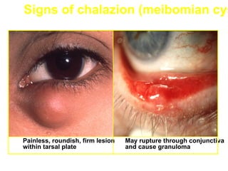Signs of chalazion (meibomian cys




Painless, roundish, firm lesion   May rupture through conjunctiva
within tarsal plate               and cause granuloma
 
