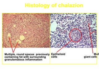 Histology of chalazion




Multiple, round spaces previously Epithelioid           Mult
containing fat with surrounding   cells         giant cells
granulomatous inflammation
 