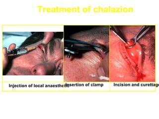 Treatment of chalazion




                            Insertion of clamp
Injection of local anaesthetic                   Incision and curettage
 
