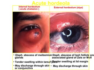 Acute hordeola
    Internal hordeolum          External hordeolum (stye)
    ( acute chalazion )




• Staph. abscess of meibomian Staph. abscess of lash follicle and
                               •
  glands                         associated gland of Zeis or Moll
• Tender swelling within tarsal•plate
                                 Tender swelling at lid margin
• May discharge through skin • May discharge through skin
  or conjunctiva
 