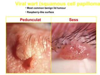 Viral wart (squamous cell papilloma
    • Most common benign lid tumour
    • Raspberry-like surface


 Pedunculat                           Sess
 ed                                   ile
 