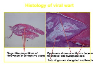Histology of viral wart




Finger-like projections of      Epidermis shows acanthosis (increas
fibrovascular connective tissue thickness) and hyperkeratosis
                               Rete ridges are elongated and bent in
 