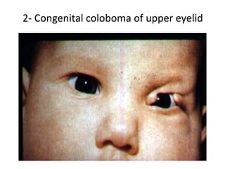 2- Congenital coloboma of upper eyelid
 