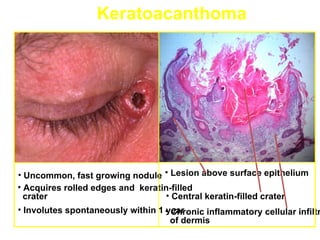 Keratoacanthoma




• Uncommon, fast growing nodule • Lesion above surface epithelium
• Acquires rolled edges and keratin-filled
  crater                          • Central keratin-filled crater
• Involutes spontaneously within 1 • Chronic inflammatory cellular infiltr
                                   year
                                     of dermis
 