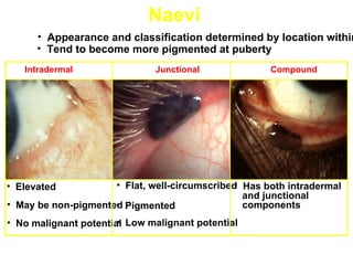 Naevi
      • Appearance and classification determined by location within
      • Tend to become more pigmented at puberty
   Intradermal                Junctional             Compound




• Elevated           • Flat, well-circumscribed Has both intradermal
                                              •
                                                and junctional
• May be non-pigmented Pigmented
                     •                          components
                       •
• No malignant potential Low malignant potential
 