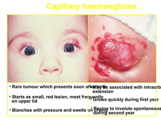 Capillary haemangioma




• Rare tumour which presents soon after birth associated with intraorbi
                                        • May be
                                          extension
• Starts as small, red lesion, most frequently
  on upper lid                          • Grows quickly during first year

                                     • crying
• Blanches with pressure and swells on Begins to involute spontaneous
                                       during second year
 