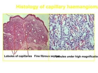 Histology of capillary haemangioma




Lobules of capillaries Fine fibrous septae
                                       Lobules under high magnification
 