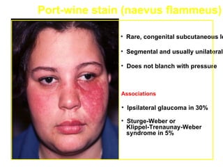 Port-wine stain (naevus flammeus)

              • Rare, congenital subcutaneous le

              • Segmental and usually unilateral

              • Does not blanch with pressure



              Associations

               • Ipsilateral glaucoma in 30%

              • Sturge-Weber or
                Klippel-Trenaunay-Weber
                syndrome in 5%
 