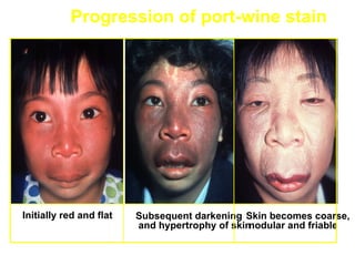 Progression of port-wine stain




Initially red and flat   Subsequent darkening Skin becomes coarse,
                         and hypertrophy of skinnodular and friable
 