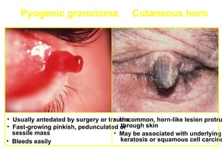 Pyogenic granuloma                   Cutaneous horn




• Usually antedated by surgery or trauma
                                    • Uncommon, horn-like lesion protru
                                      through skin
• Fast-growing pinkish, pedunculated or
  sessile mass                      • May be associated with underlying
• Bleeds easily                       keratosis or squamous cell carcino
 