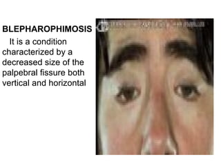 BLEPHAROPHIMOSIS
  It is a condition
characterized by a
decreased size of the
palpebral fissure both
vertical and horizontal
 