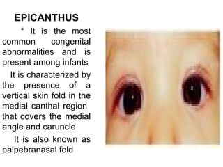 EPICANTHUS
       * It is the most
common         congenital
abnormalities and is
present among infants
  It is characterized by
the presence of a
vertical skin fold in the
medial canthal region
that covers the medial
angle and caruncle
    It is also known as
palpebranasal fold
 