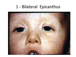 1 - Bilateral Epicanthus
 