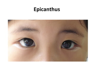 Epicanthus
 