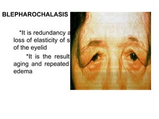BLEPHAROCHALASIS

    *It is redundancy and
  loss of elasticity of skin
  of the eyelid
        *It is the result of
  aging and repeated lid
  edema
 