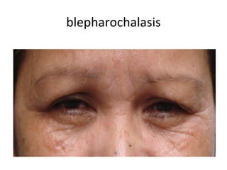 blepharochalasis
 