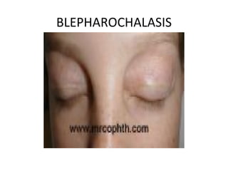 BLEPHAROCHALASIS
 