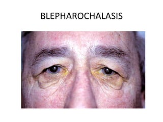 BLEPHAROCHALASIS
 