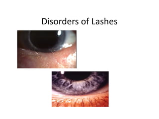 Disorders of Lashes
 