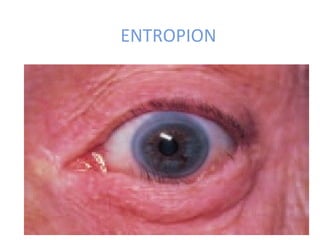 ENTROPION
 