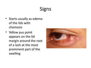 Signs
• Starts usually as edema
  of the lids with
  chemosis
• Yellow pus point
  appears on the lid
  margin around the root
  of a lash at the most
  prominent part of the
  swelling
 