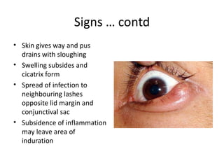 Signs … contd
• Skin gives way and pus
  drains with sloughing
• Swelling subsides and
  cicatrix form
• Spread of infection to
  neighbouring lashes
  opposite lid margin and
  conjunctival sac
• Subsidence of inflammation
  may leave area of
  induration
 