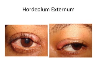 Hordeolum Externum
 