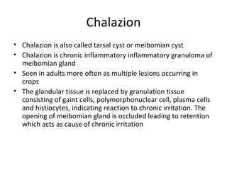 Chalazion
• Chalazion is also called tarsal cyst or meibomian cyst
• Chalazion is chronic inflammatory inflammatory granuloma of
  meibomian gland
• Seen in adults more often as multiple lesions occurring in
  crops
• The glandular tissue is replaced by granulation tissue
  consisting of gaint cells, polymorphonuclear cell, plasma cells
  and histiocytes, indicating reaction to chronic irritation. The
  opening of meibomian gland is occluded leading to retention
  which acts as cause of chronic irritation
 