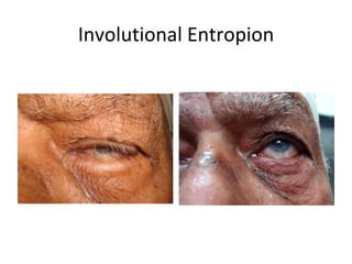 Involutional Entropion
 