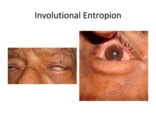 Involutional Entropion
 