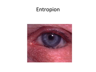 Entropion
 
