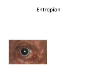 Entropion
 