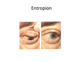 Entropion
 