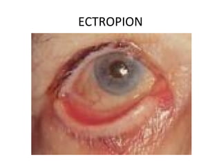 ECTROPION
 