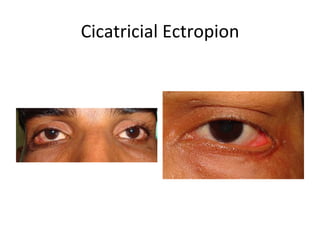 Cicatricial Ectropion
 