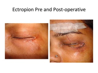 Ectropion Pre and Post-operative
 