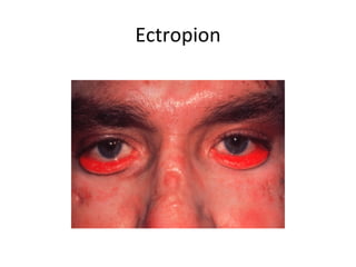 Ectropion
 