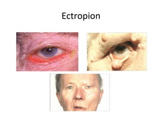 Ectropion
 