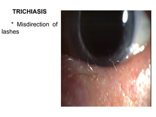 TRICHIASIS

    * Misdirection of
lashes
 