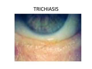 TRICHIASIS
 