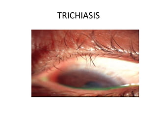 TRICHIASIS
 